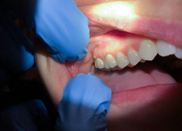 Best Broken or Chipped Tooth Repair in Belle Plaine, KS
